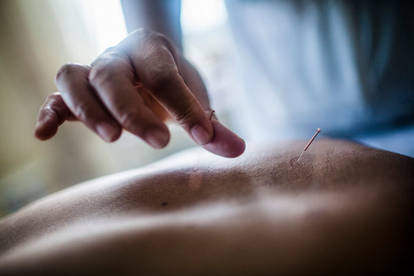 Close up of hand holding fine needle, performing acupuncture on a patient's back